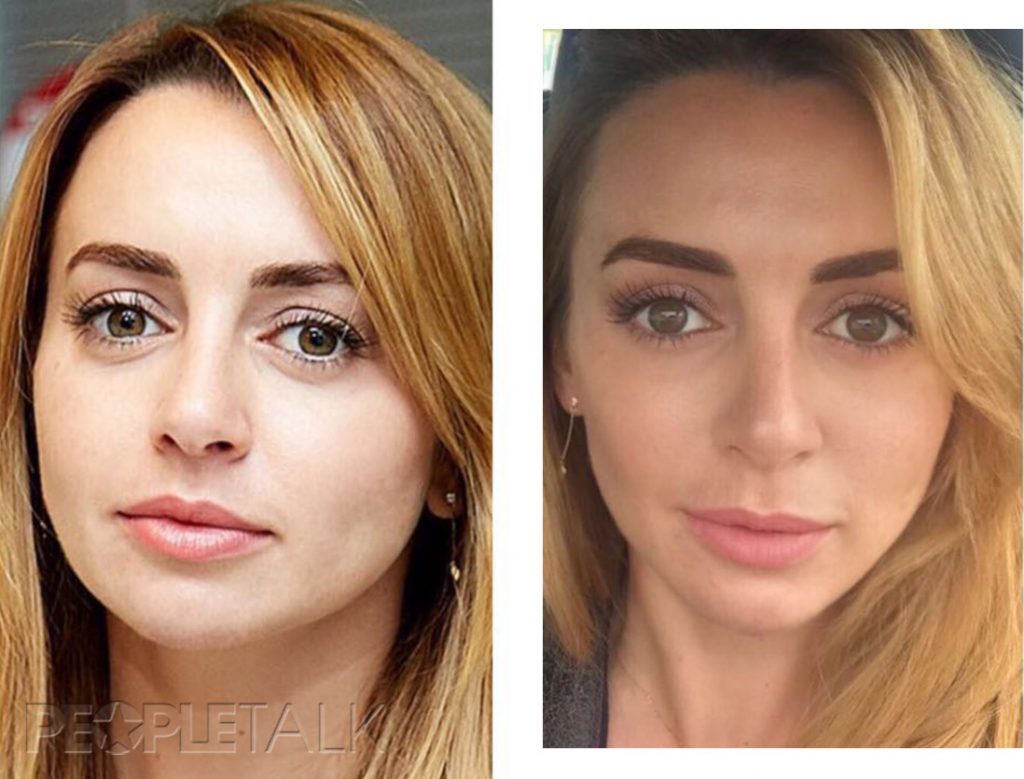 Ревва александр пластика лица до и после фото